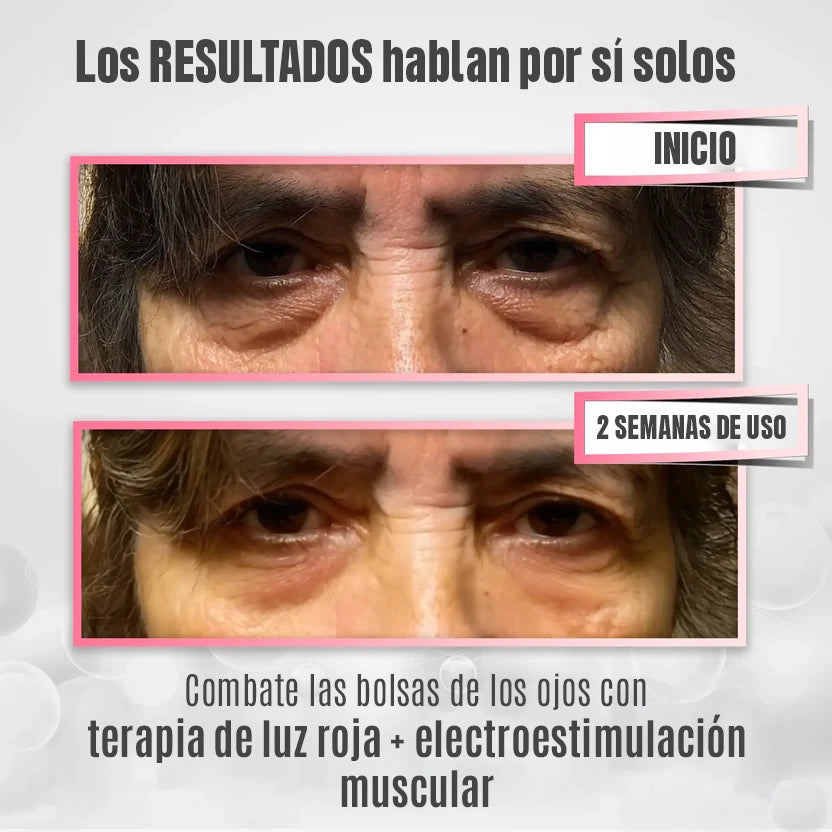 RevitalEyes® 2 en 1: Terapia de Luz Roja y EMS para Eliminar Bolsas de los Ojos