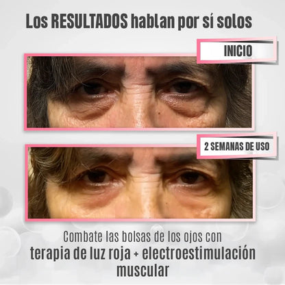 RevitalEyes® 2 en 1: Terapia de Luz Roja y EMS para Eliminar Bolsas de los Ojos